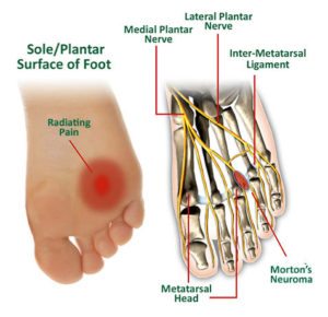 Morton's Neuroma