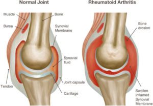 Best Shoes For Arthritic Knees Best Shoes For Arthritic Knees