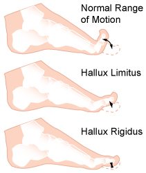 Hallux limitus