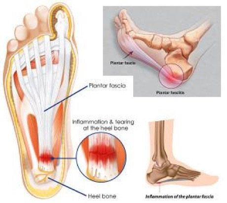 What is Plantar Fasciitis