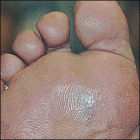 shoes for callus on ball of foot