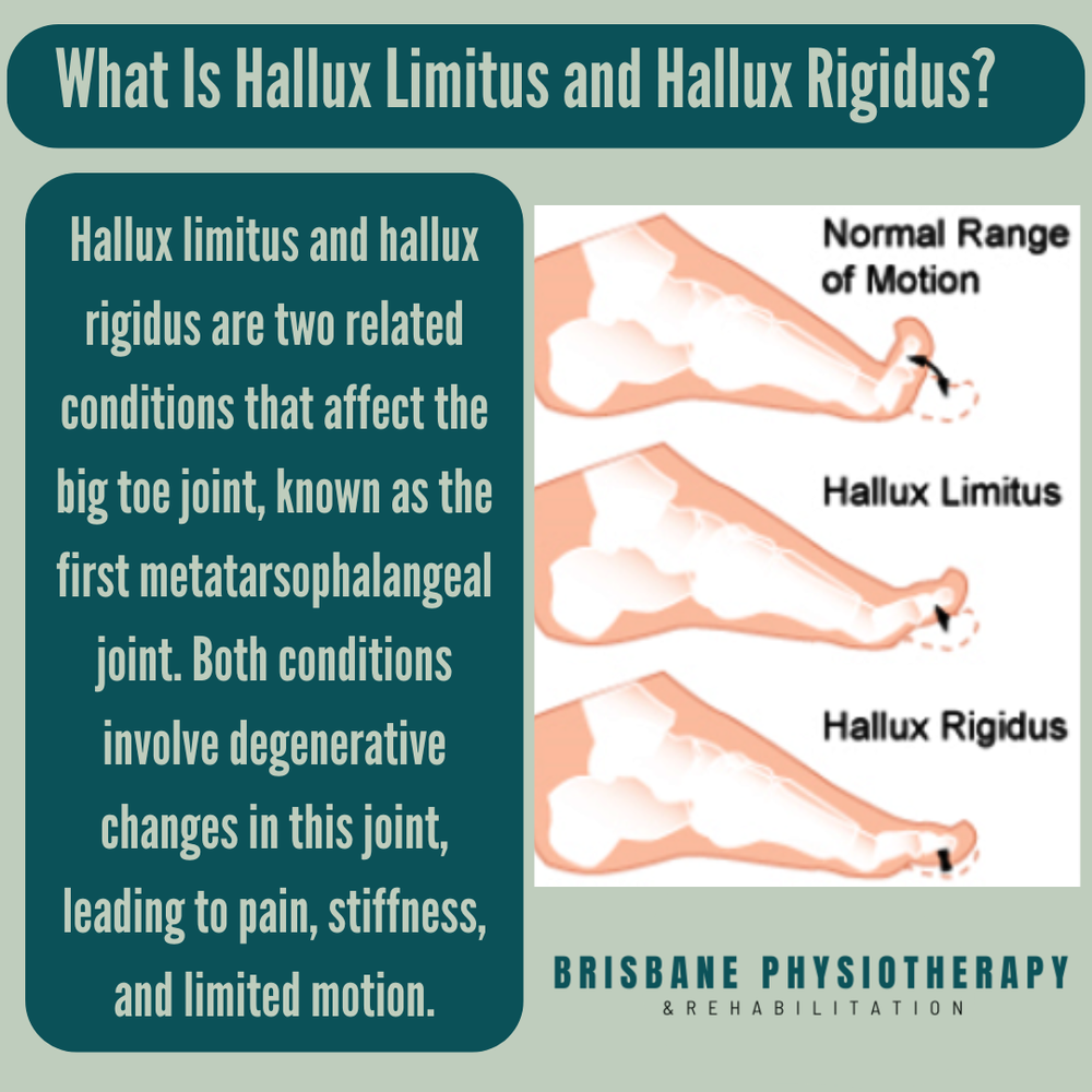 what is hallux limitus and hallux rigidus